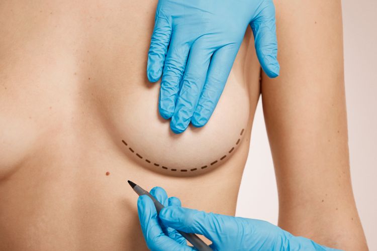 Breast Implant Surgery